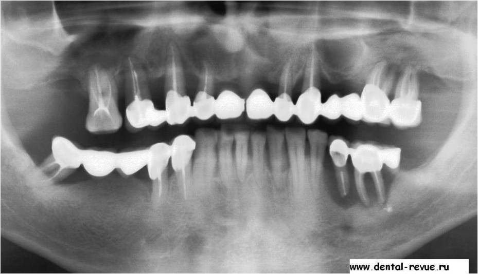 Частичный случай. Ортопантомограмма пародонтит. Генерализованный пародонтит тяжелой степени ОПТГ. Пародонтоз ортопантомография.
