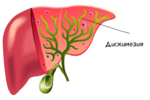 Дискинезия желчевыводящих путей картинки